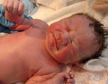 新生儿出生时“手握”避孕环 避孕环的危害