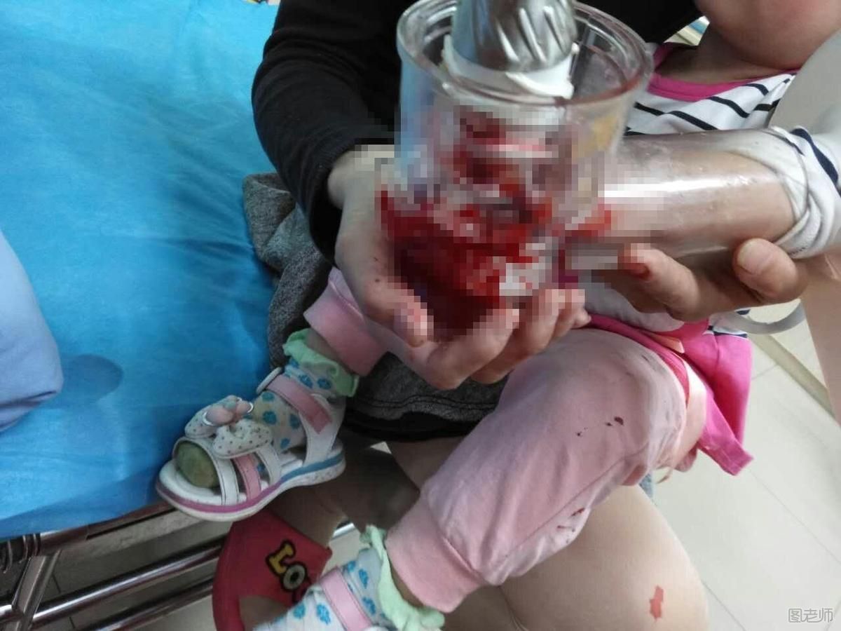 长沙2岁女孩被手被榨汁机搅伤 使用榨汁机时要注意什么
