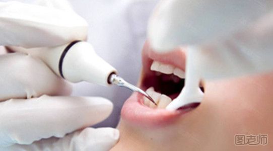  超声波洁牙需要多长时间 不同牙齿洗牙时间不同你造吗