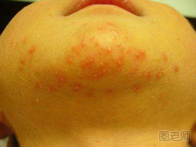 湿疹和痱子是相同的吗？湿疹和痱子有哪些区别？