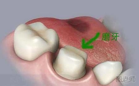 怎样防治磨牙症
