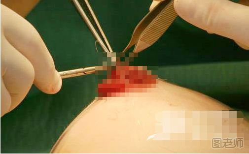 丰胸手术全过程 丰胸手术视频过程