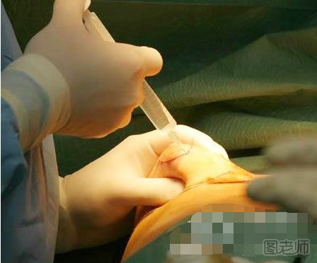 丰胸手术全过程 丰胸手术视频过程