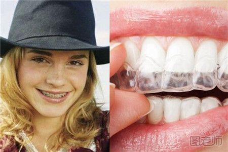 牙套有哪几种 怎么选择牙套