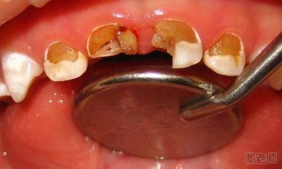 乳牙龋齿有哪些危害 