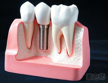种植牙的过程是怎么样的？