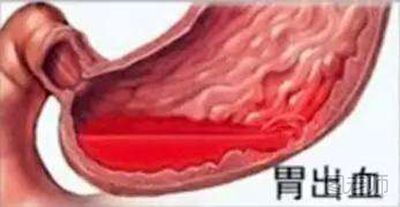 胃出血2.jpg