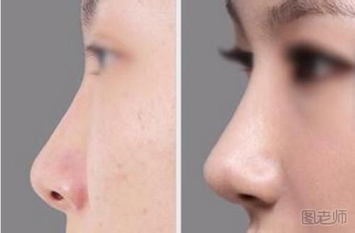 自体软骨隆鼻的危害是什么