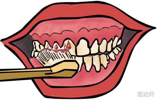 牙龈出血是缺少什么维生素 牙龈出血怎么治疗