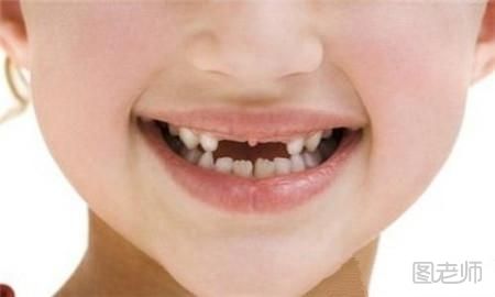 换牙期间的注意事项    换牙期怎样护理