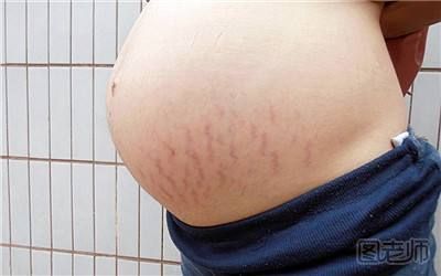 怀孕为什么会长妊娠纹