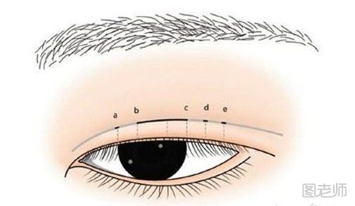 三点定位双眼皮是什么 三点定位双眼皮是永久的吗
