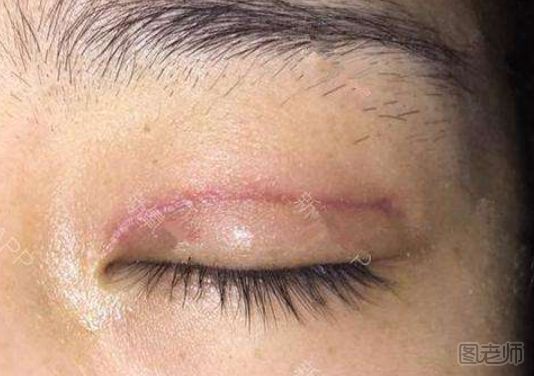 疤痕体质可以割双眼皮吗 割双眼皮要注意什么