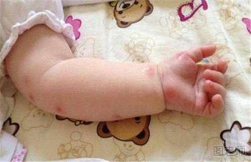 宝宝被蚊子咬了怎么止痒消肿
