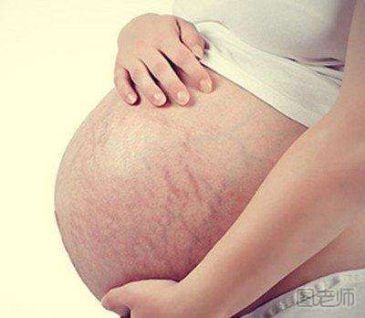 什么是妊娠纹