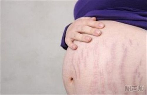 孕期为什么会长妊娠纹