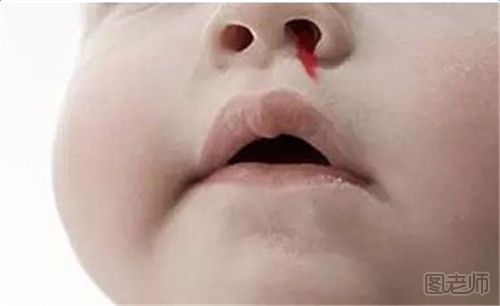 如何预防小孩流鼻血