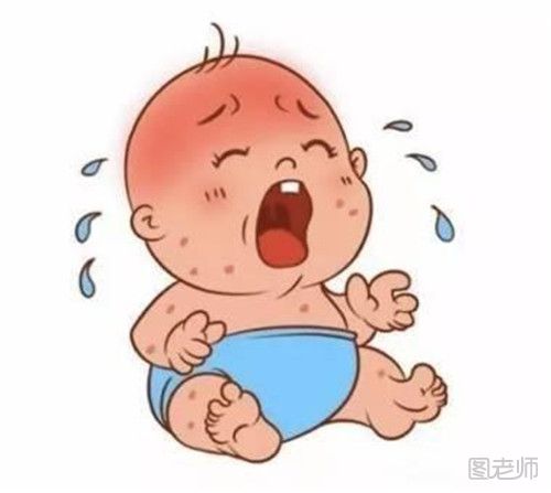 婴儿湿疹的症状 婴儿湿疹洗脸前注意什么