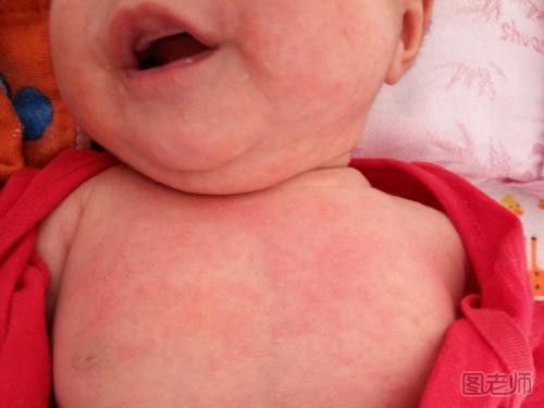 湿疹传染吗 宝宝为什么容易长湿疹