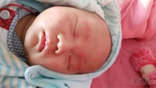 宝宝皮肤湿疹可能是过敏吗 宝宝湿疹后皮肤变黑
