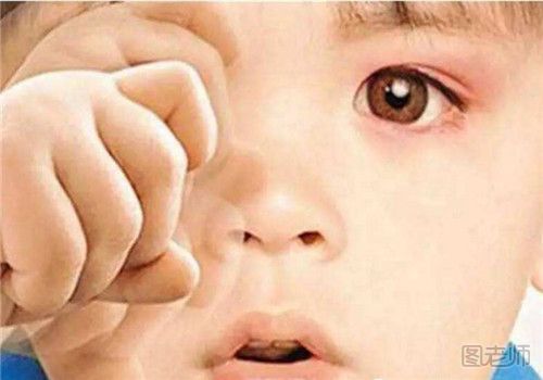 宝宝眼睛红肿怎么紧急处理 宝宝眼睛红肿的原因有哪些.jpg