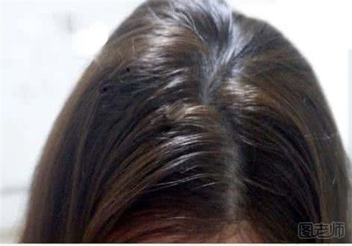 头发油日常生活中怎么做 造成头发油的原因有哪些jpg
