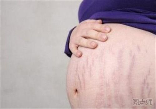 孕妇怎么预防长妊娠纹 预防妊娠纹从这几点做起.jpg